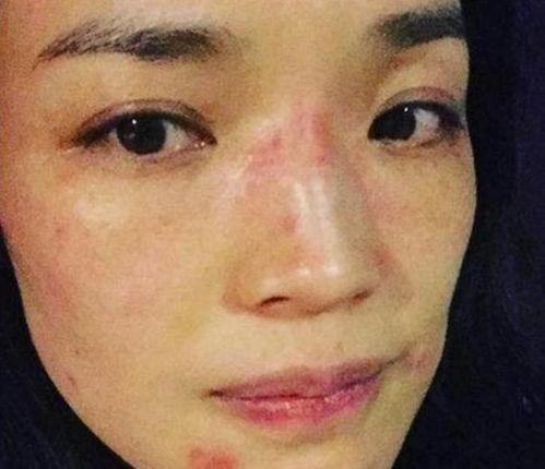 痘痘明星,揭秘明星护肤秘籍，告别痘痘困扰